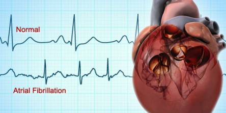 Atrial fibrillation