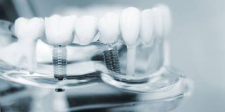 Choosing Between Immediate or Delayed Dental Implants