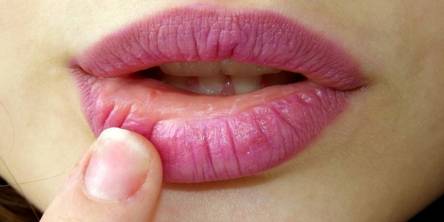dry lip causes