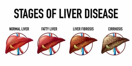 Fatty Liver Disease