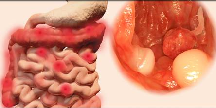 ulcerative colitis