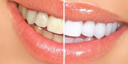 Teeth Whitening, Whiten Your Teeth